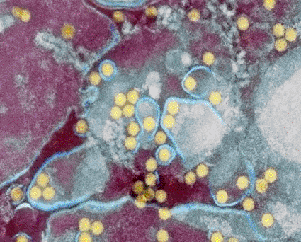 Imagen: Microfotografía electrónica de transmisión a color (TEM) de partículas del virus de la fiebre del dengue (amarillas) en una célula (Fotografía cortesía de la Escuela de Higiene & Medicina Tropical de Londres)